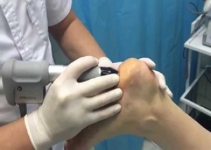 Пяточная шпора. Подошвенный фасциит I Кинезиолог в Ялте